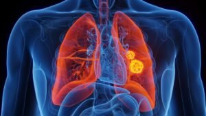 Lung cancer due to smoking